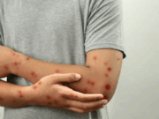 La OMS advierte de contagio masivo si no se controla la viruela del mono