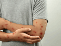 La OMS advierte de contagio masivo si no se controla la viruela del mono