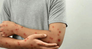 La OMS advierte de contagio masivo si no se controla la viruela del mono